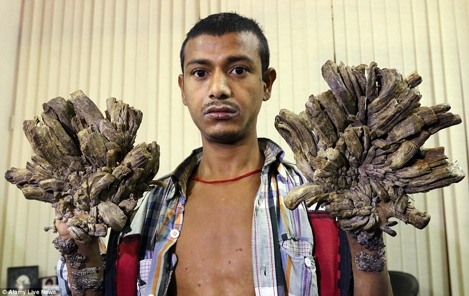 Image result for bangladeshi tree man