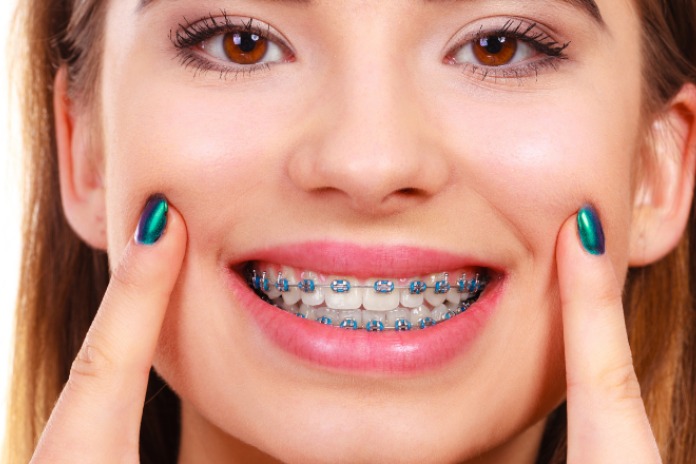 Braces in South Africa