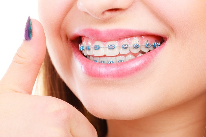 Braces in South Africa