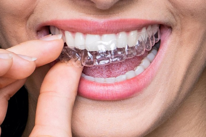 braces transparent teeth