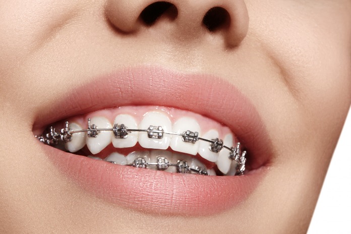 Braces in South Africa